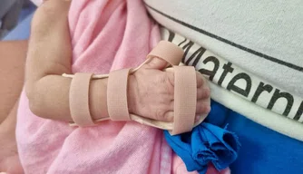 Nova Maternidade Dona Evangelina Rosa produz órteses para prematuros